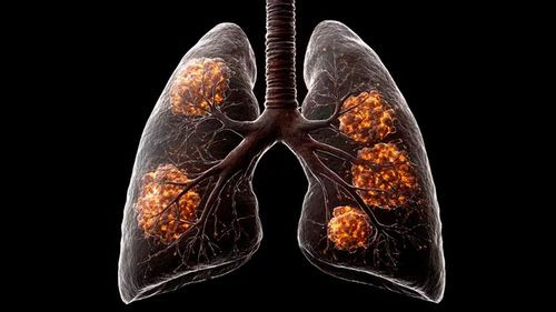 Contaminación del aire aumenta casos de cáncer de pulmón en no fumadores: un problema global