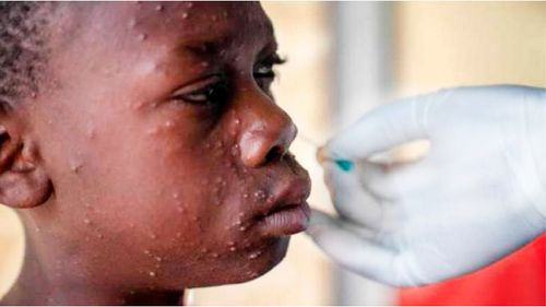 África en alerta: Casi 21.500 casos de Mpox y más de 590 muertes desde enero