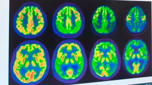 Innovadora terapia por ultrasonido ofrece esperanza en el tratamiento del Alzheimer y la adicción a las drogas