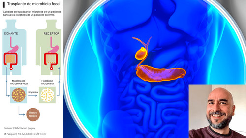 Trasplante fecal: esperanza en colangitis esclerosante